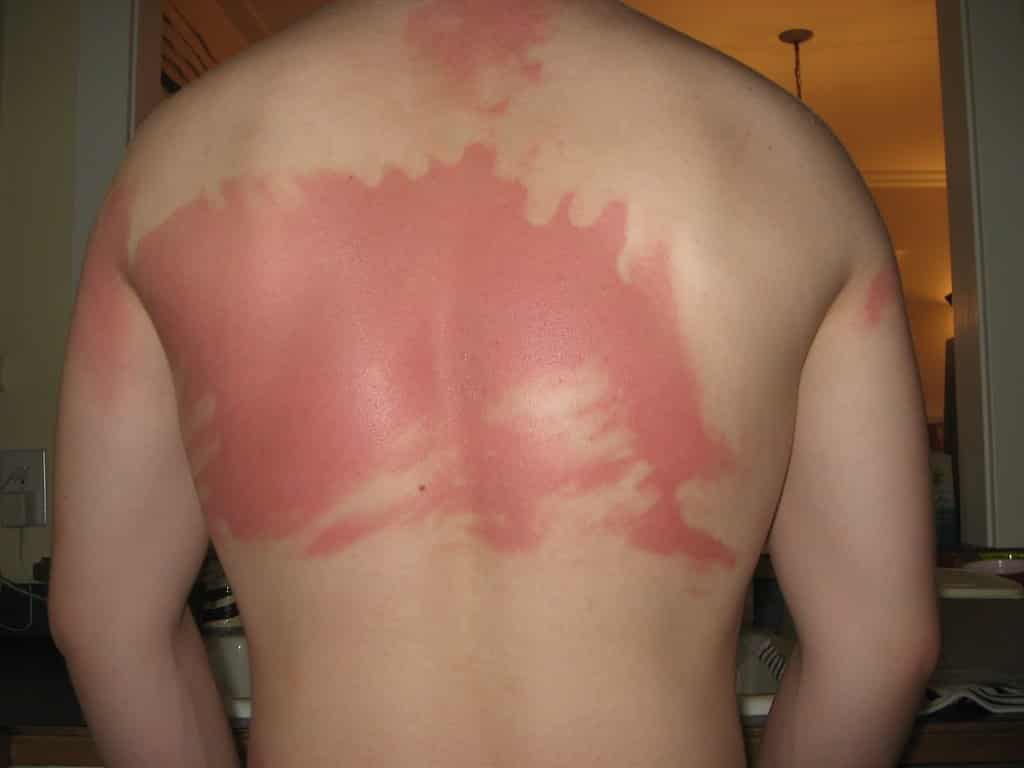 Man sunburnt after booking a surf camp in Portugal